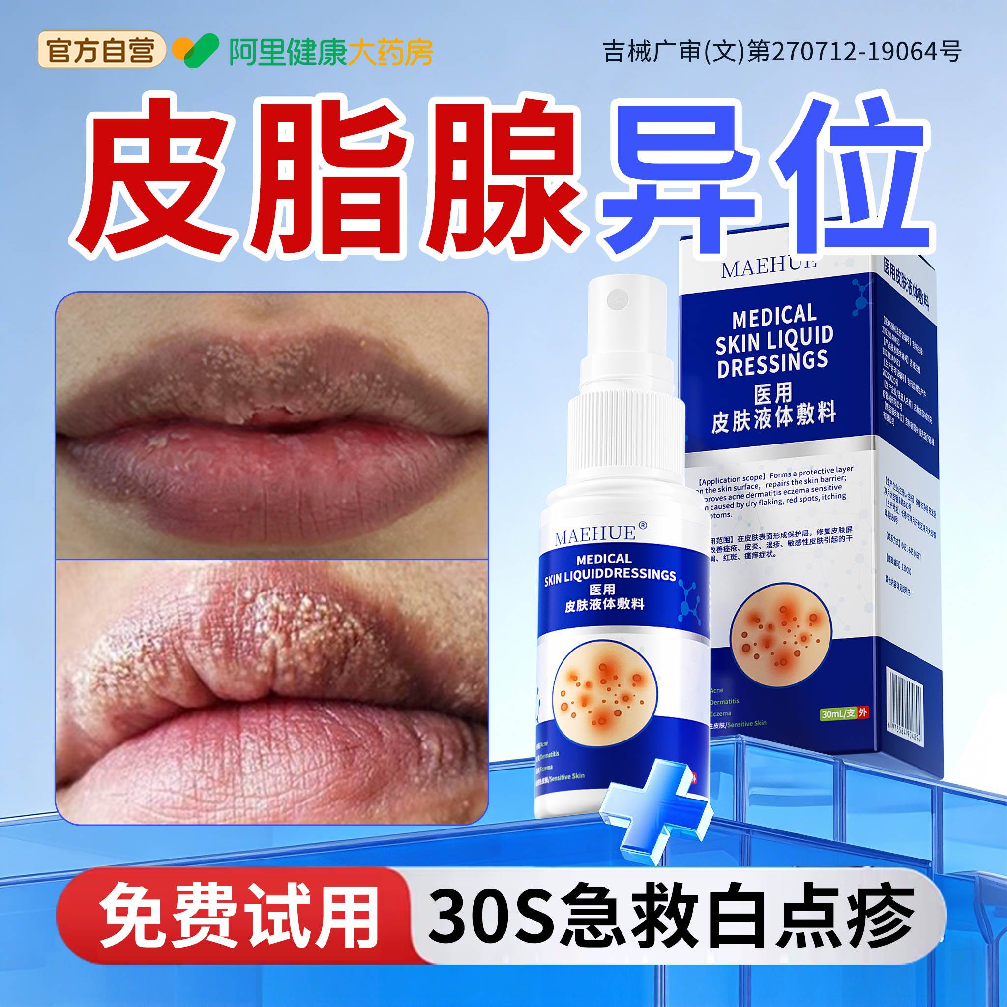 皮脂腺异位症嘴唇白点脂肪小颗粒干裂脱皮炎疱疹药真菌感染膏面部