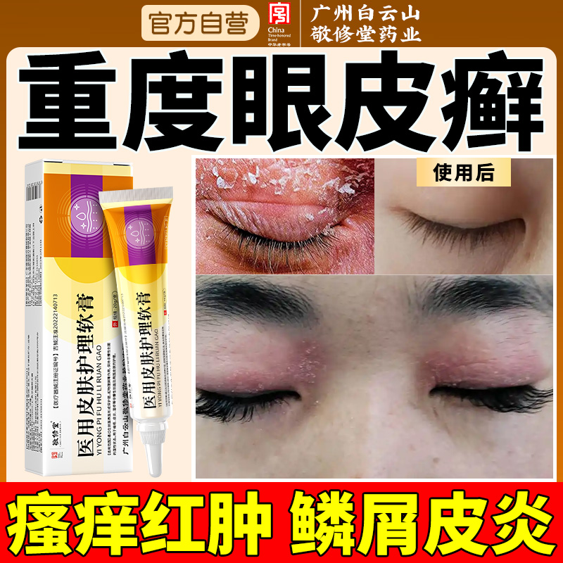眼皮癣红肿眼睛周围痒过敏发痒正品眼膏止痒眼角里面痒干燥起皮炎