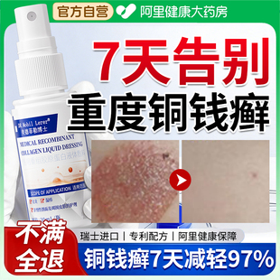 铜钱癣专用特效皮肤瘙痒止痒外用皮癣猫藓人用真菌感染杀菌止痒膏