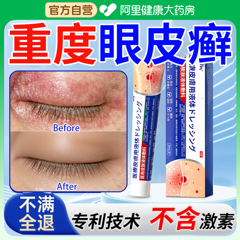 眼皮癣眼睛周围眼角痒干燥起皮掉屑红肿过敏发痒神经性皮炎神器药