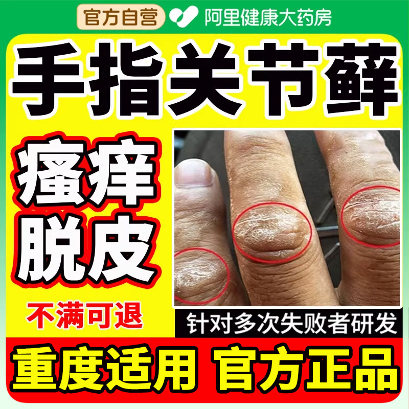 手指关节癣真菌感染手癣膏药长硬疙瘩伤癣脱皮干裂口硬块硬皮瘙痒