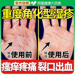手部角化型非手癬膏脫皮干裂真菌感染手足癬手指關(guān)節(jié)非濕疹非藥膏