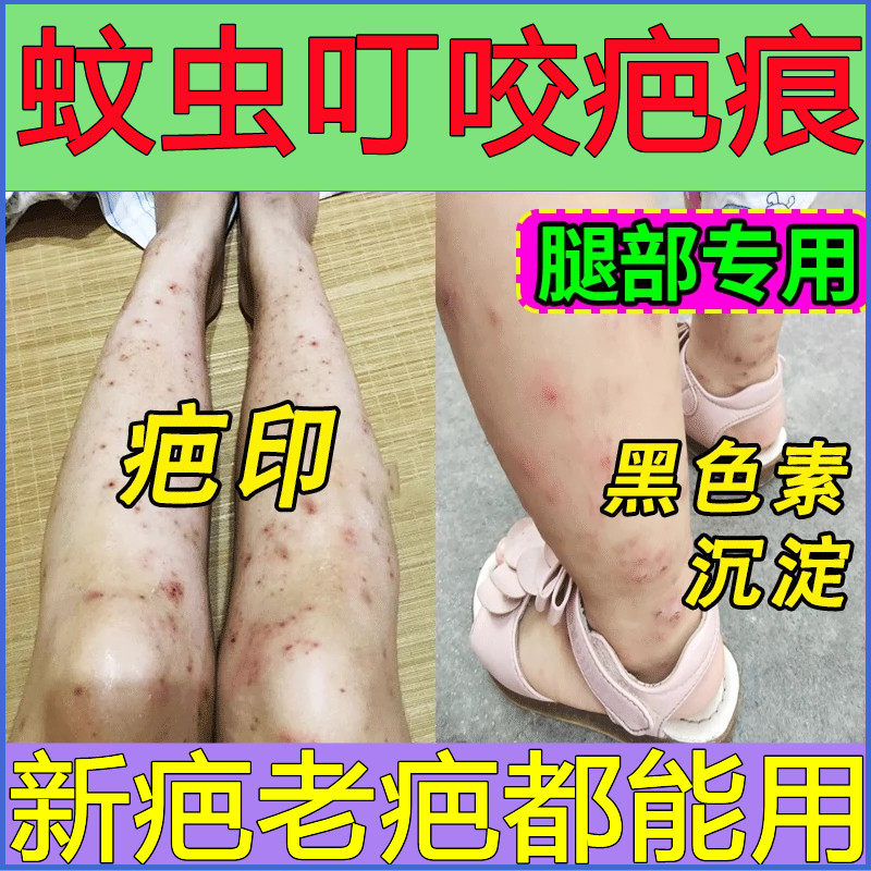 蚊虫叮咬祛疤膏疤痕去黑印黑色素沉淀蚊子跳蚤咬的印儿童修复凝胶图片