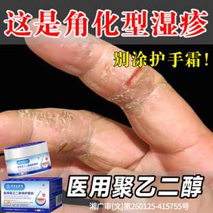 手指裂口出血专足跟治开裂手足皲裂膏角化型起硬皮干燥脱皮修复霜