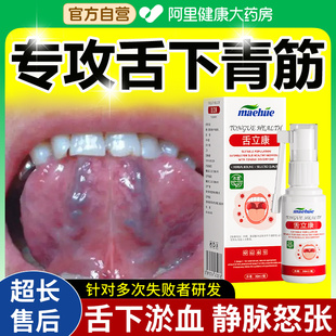 舌下青筋又黑又粗淤血紫非疏通血管底溶栓专用口腔炎舌立康喷剂