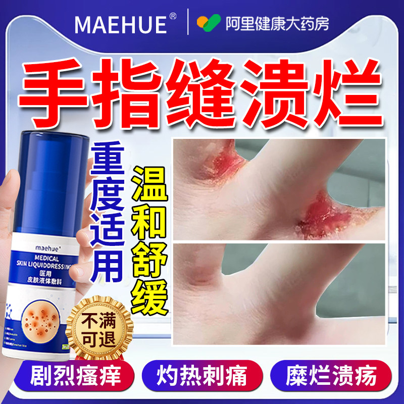 手指缝溃烂止痒脱皮水泡手气糜烂瘙痒手癣膏真菌感染烂手丫间药膏