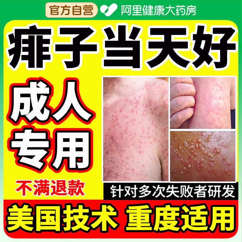 成人专用痱子水止痒祛痱液体金银花去痱粉夏季大人去热痱红疹喷雾