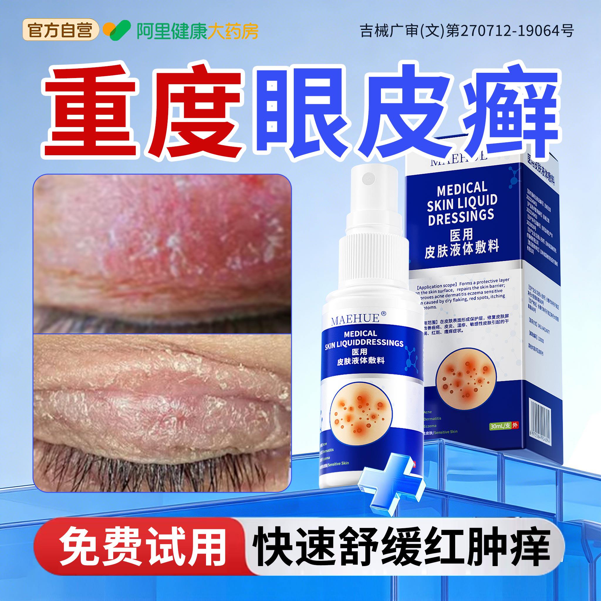 眼皮癣眼睛周围眼角周痒干燥起皮掉屑红肿专用藓膏过敏神经性皮炎
