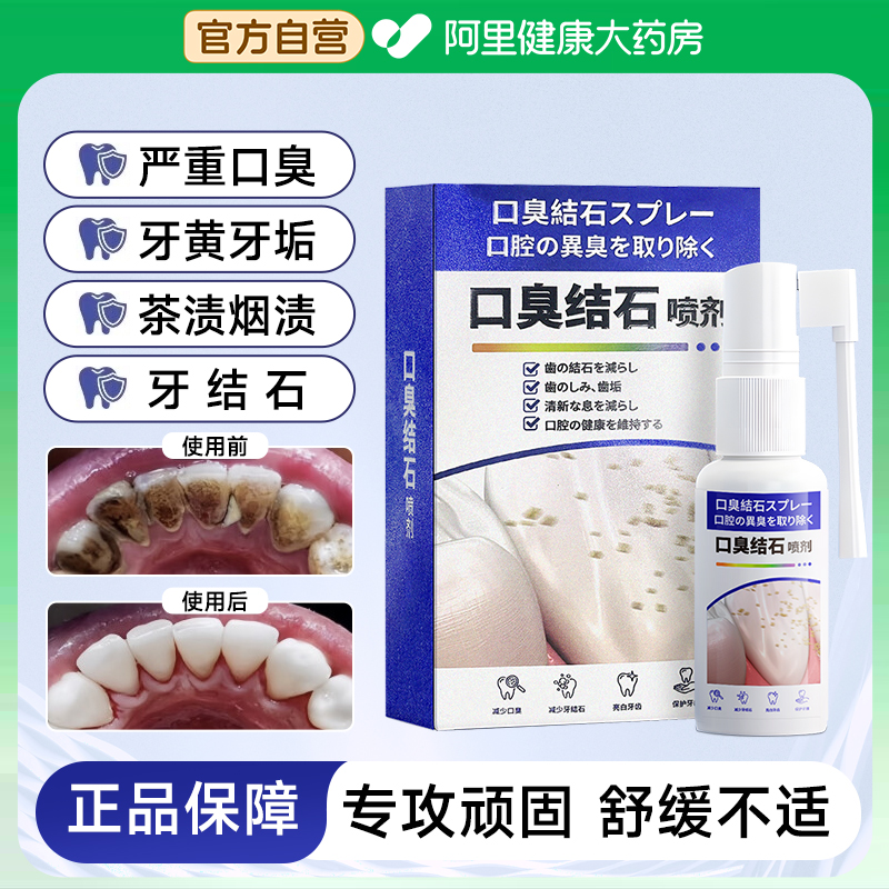 牙结石口腔喷剂冲洗器喷雾牙膏口臭去黄溶解牙垢牙渍清新口气神器