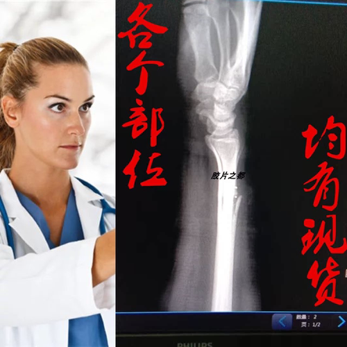 医用胶片蓝片干式CT DR CR 牙科骨折脑壳X光片放射科定制打印胶片