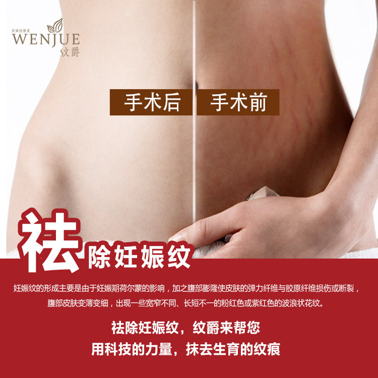 [禧月帮孕产服务淘宝店铺优惠券]妊娠纹修复彻底根除术20000元抵用月销量0件仅售10000元