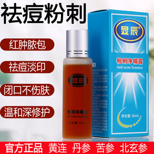 显辰祛痘精华液粉刺净精露控油淡化痘印去闭口青春痘痘学生祛痘水