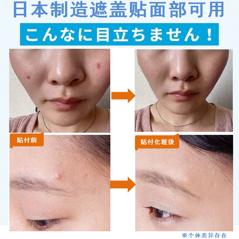 日本产脸部疤痕痘印痘痕遮盖贴薄图片