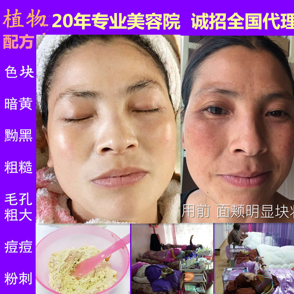 美容院专用醋疗套装保湿草药醋疗面膜粉老品一号套组醋膜配套