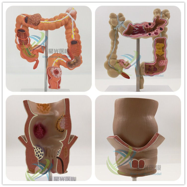 starlight Colon Pathology Model The large intestine Rectum Pathological changes specimen Intestine Patient communicate human body Organ anatomyin the Toy/Childs/Puzzle/Building block/Model , Static model , Other model toys  category - from Buy2taobao.com to provide professional Taobao agent buy service