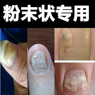 买2发3真菌性黄白甲手指甲脚趾甲发白变白发黄变黄变厚碎末