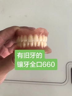 吸附性义齿假牙 活动假牙 老年人活动假牙
