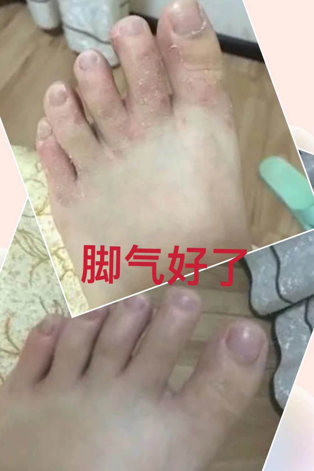 脚气10  褪皮脚汗臭痒泡痒蜕皮烂丫干裂
