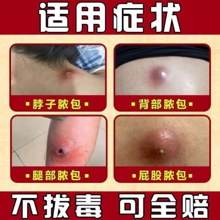 拔毒膏吸脓头毒疙瘩坐板疮肿硬块祛火疖子脓肿浓疮痘痘拔浓膏