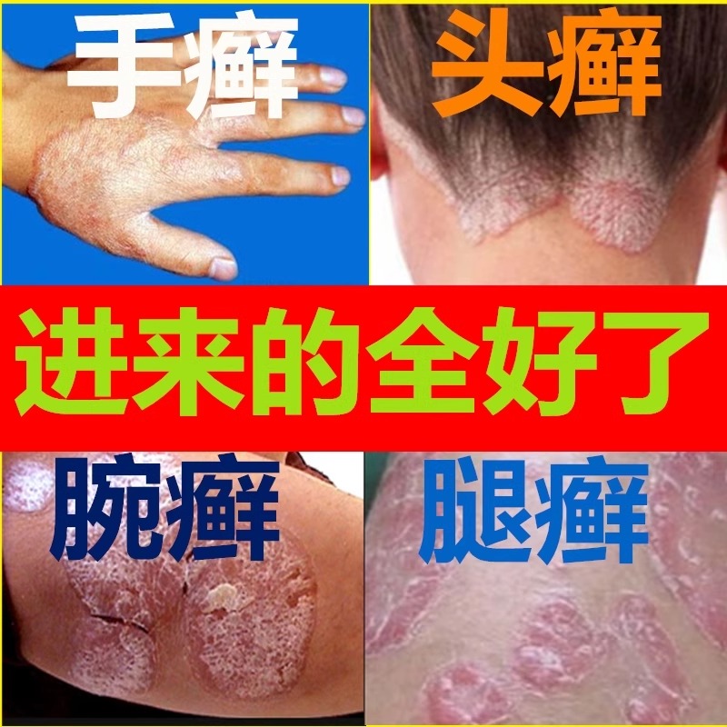 云南真菌王针对各种皮肤问题瘙痒牛皮银屑湿疹皮炎草本外用乳膏