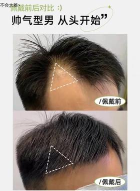 鬓角补发片贴真发无痕隐形假发片前额遮盖两鬓角补发隐形男LHAL4