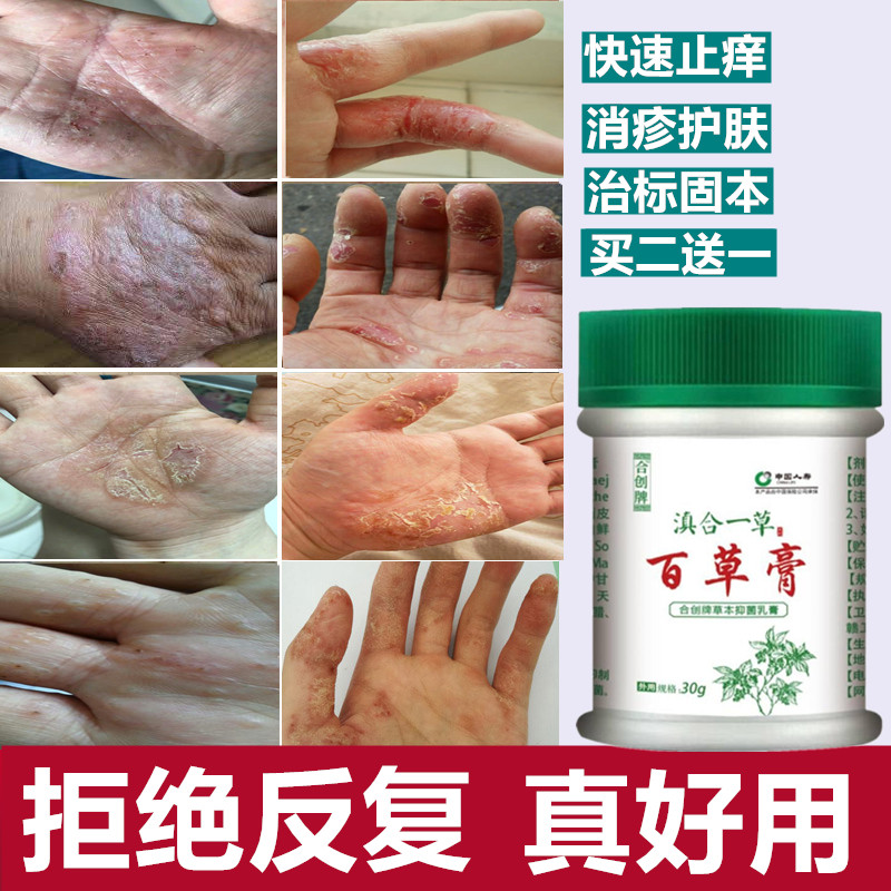 手癬膏真菌感染水泡治療皮膚溼疹專用止癢去根牛皮手足腳癬藓藥膏在類目 本地化生活服務, 健康服務, 健康服務, 在線問診, 名醫挂號中 - 來自Buy2taobao.com提供專業的淘寶代購服務