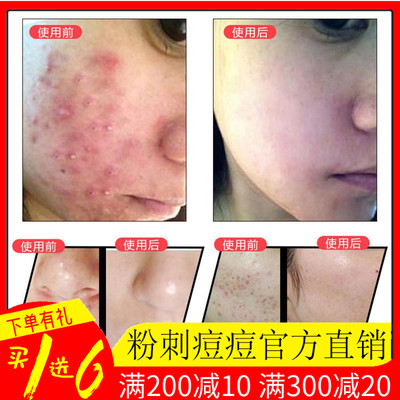 Zhangguang 101 Ruisi средство для удаления прыщей, молодёжная красота, гелевая эссенция от прыщей, уход за кожей лица, следы от прыщей