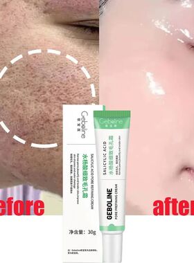 Salicylic Acid Pore Shrinking Cream Quick Remove Blackehead