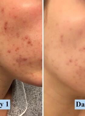 4%/10% Acne Foaming/Creamy Face Wash With Benzoyl Peroxide