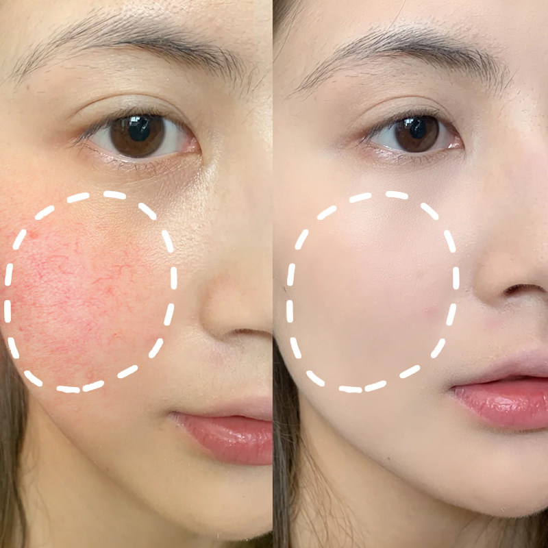 去红血丝冷敷贴晒后修复角质层增厚补水保湿敏感肌肤脸部护理面膜