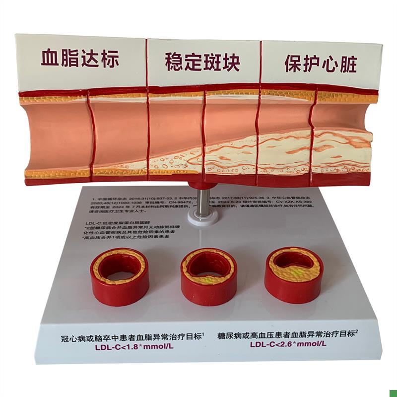 血管活动堵塞动支脉n粥样硬化心血管动脉硬化模型血管病理模型血