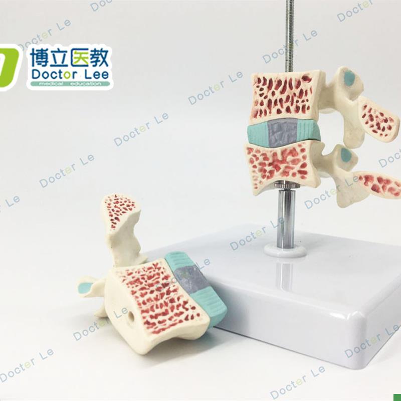 3节脊椎模型i腰椎间盘神经脊椎正中切模型骨质疏松模型