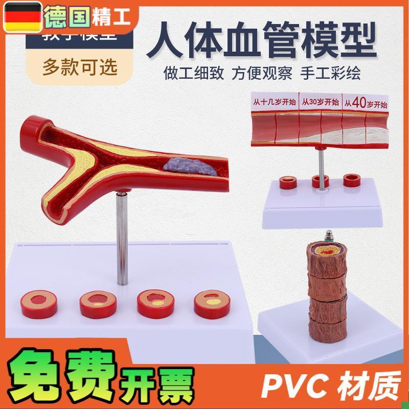 堵塞心血管模型血栓血液浓v度脂肪病理粥样硬化人体血管解剖模具