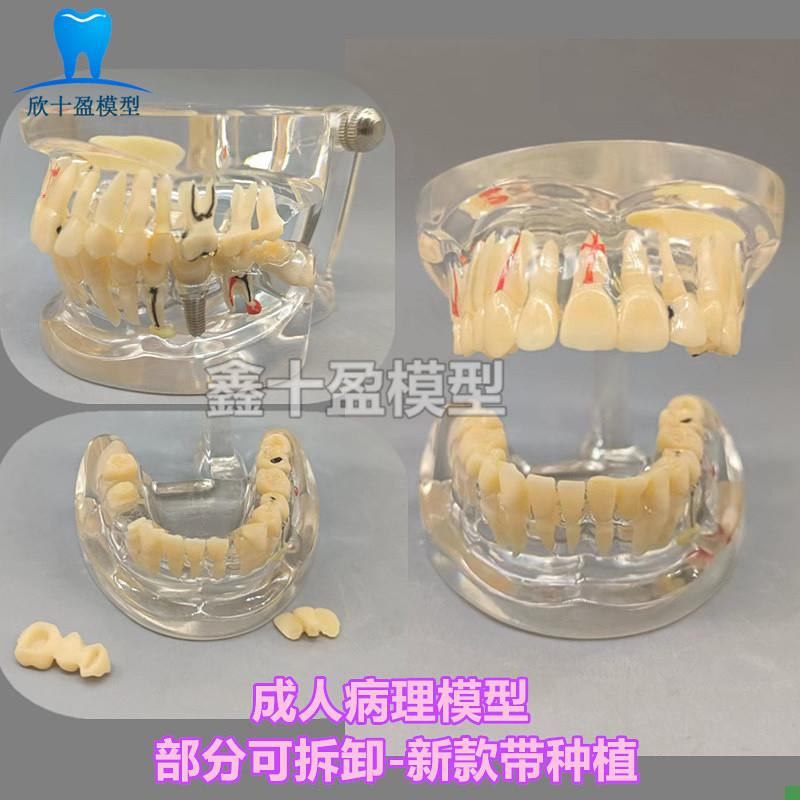 牙科牙齿b病理模型成人全口牙模型牙模医患沟通教育教学种植修复C