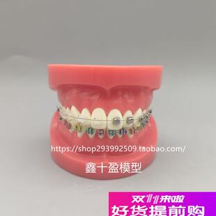 牙科正畸模型球j形金属自锁托槽正畸模型矫正练习模型医患沟通