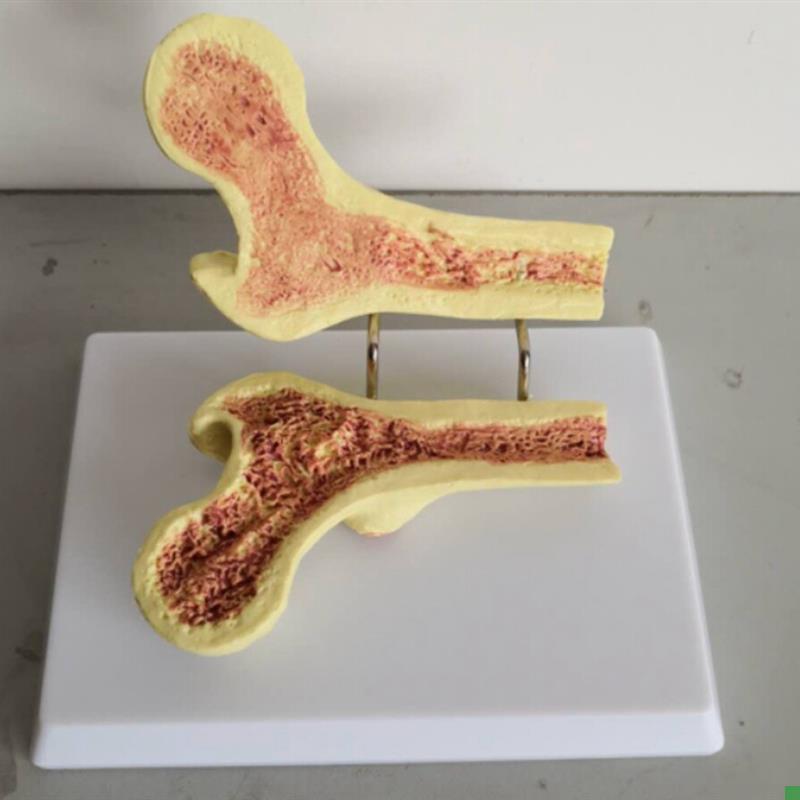 正常股骨头与病变m股骨头比较模型骨骼骨架正骨病理解说