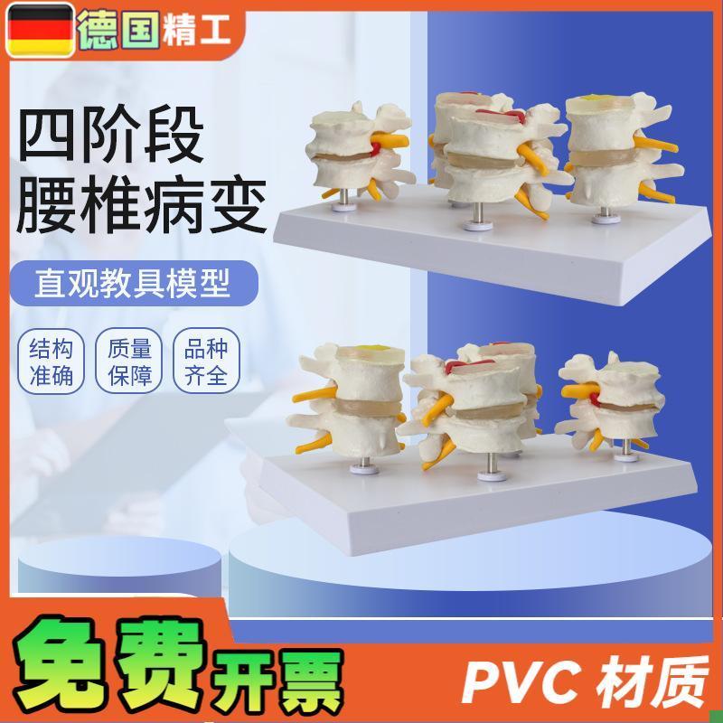德国】人体腰椎模型四阶段腰椎对比椎间盘N突出脱出演示模型骨科