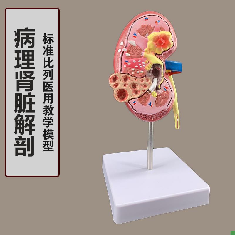 人体肾解剖模型病变肾脏模型人体器官H解剖模型病变内脏医院教学