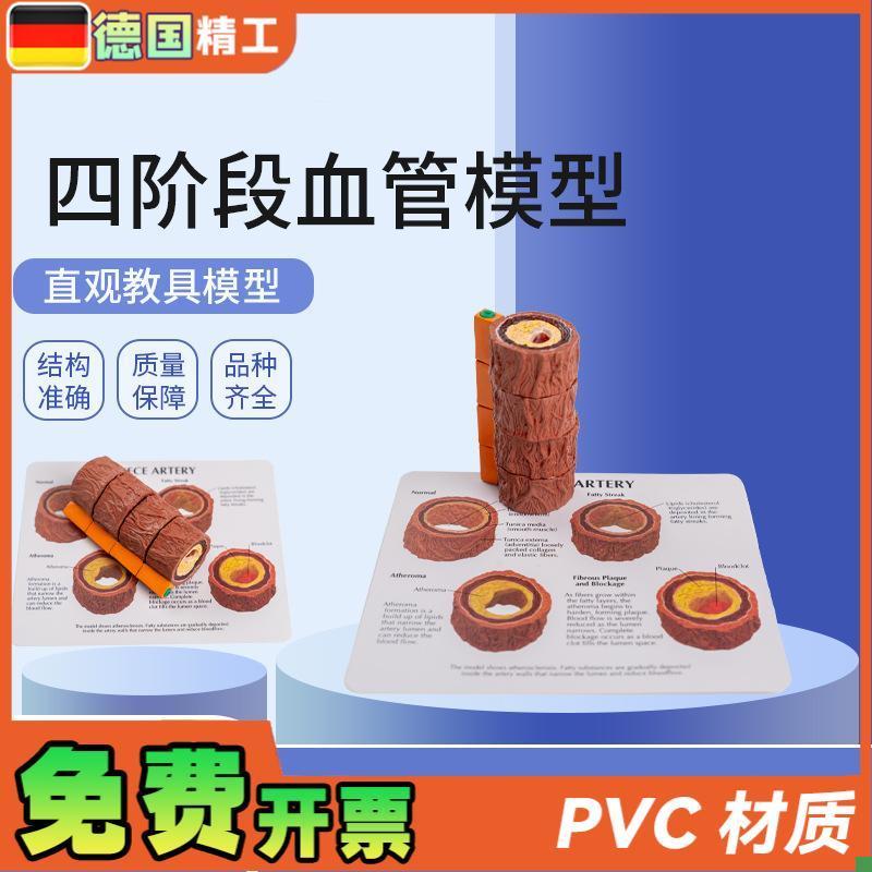 德国】血管模型人体四阶段血管标本心内H科医患沟通演示血管硬化