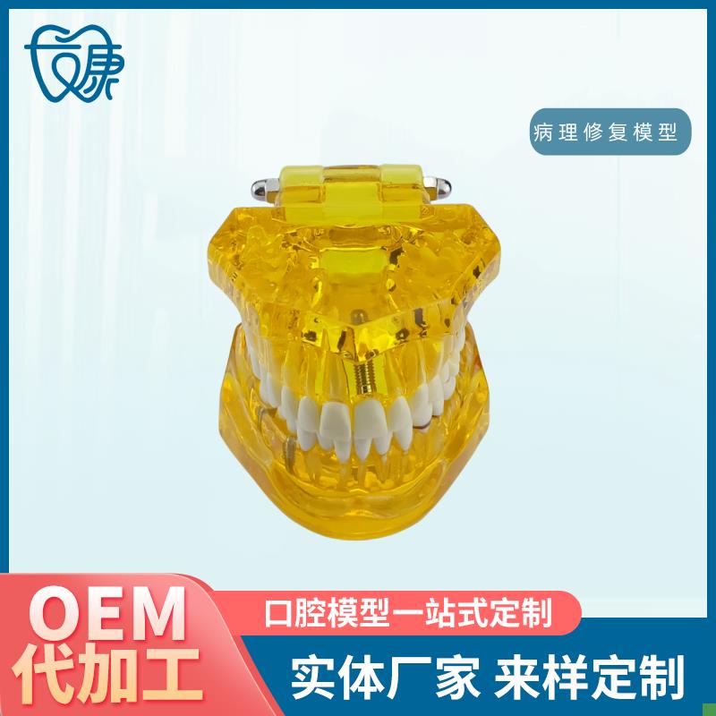 牙齿模型病理修复可拆卸正畸口腔E病理牙模型牙科医患活动沟通