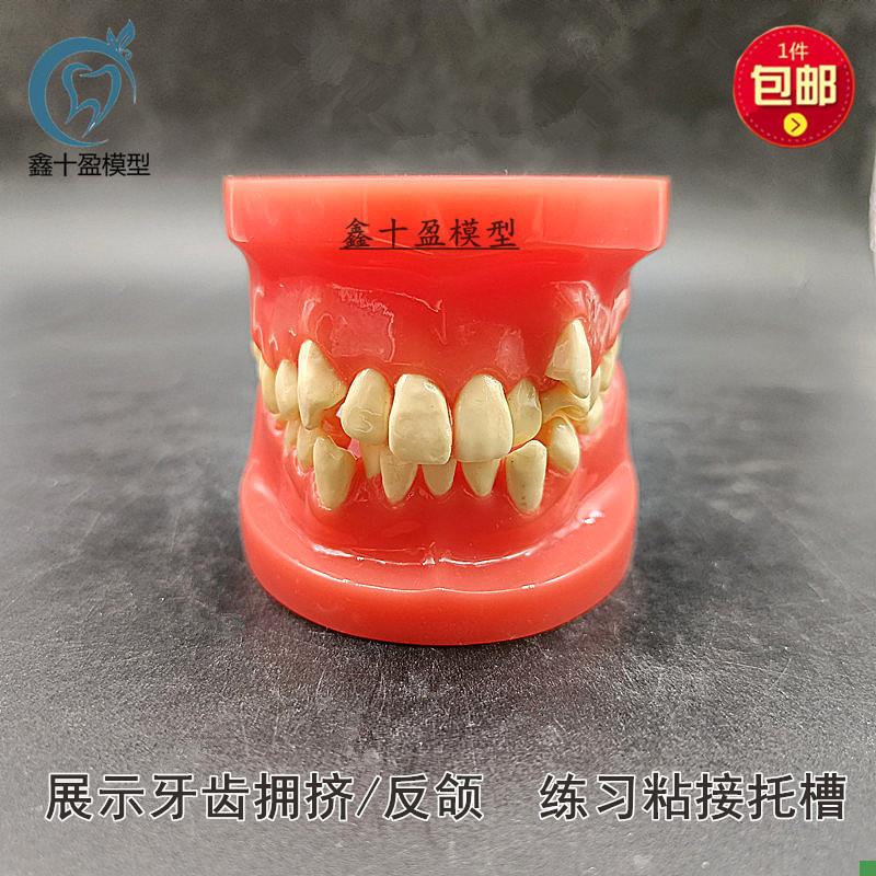 牙科正畸模型红色k错颌牙齿拥挤反颌牙模练习粘接托槽医患沟通B4