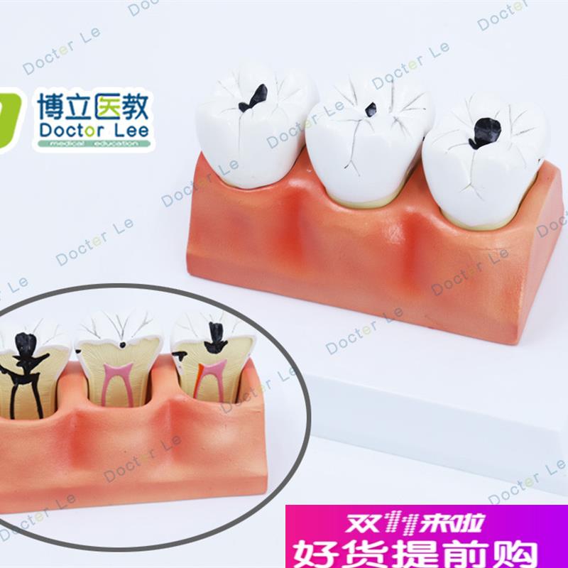 牙齿模型牙病理模n型病变牙齿模型牙齿解剖模型牙模型牙科