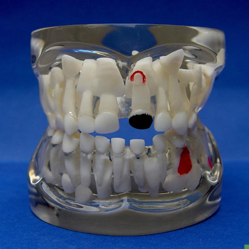 ENOVO颐e诺儿童乳牙早期病态牙列模型牙齿发育幼儿牙齿护理教学具