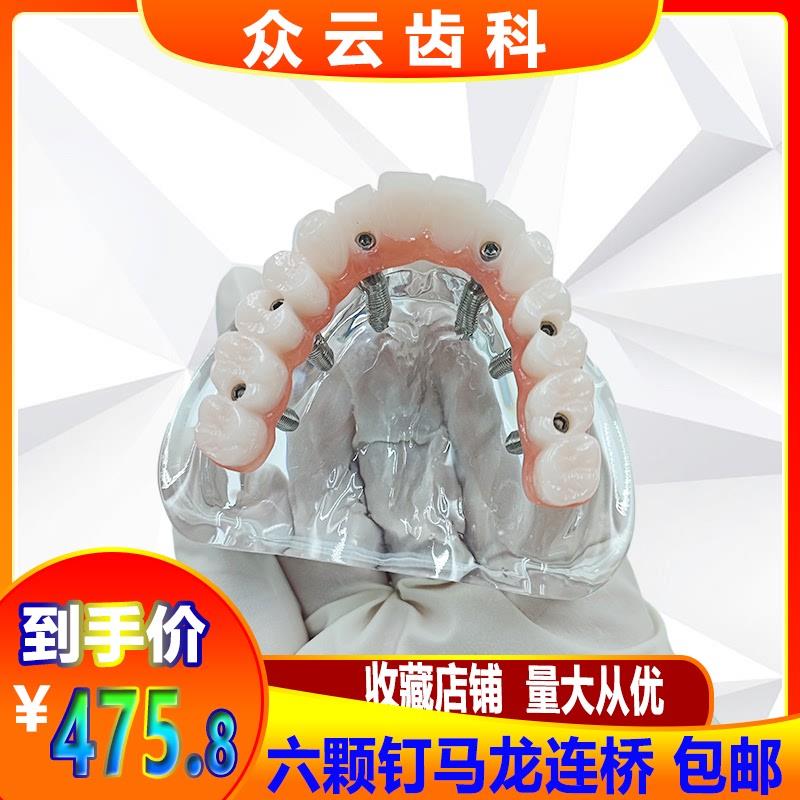 牙科口腔模型马龙连桥义齿种植修复模型I教学练习仿真演示交流模