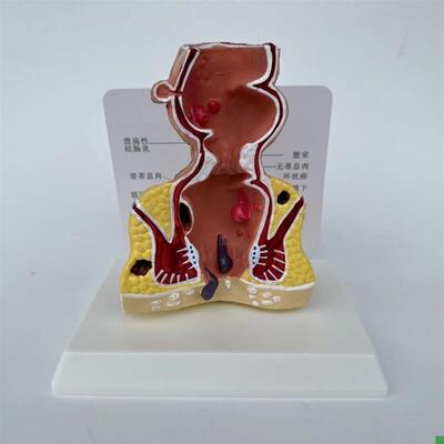 人体直肠模型肛管j裂开痔内外突出瘘管消化道结肠大肠医患病理沟