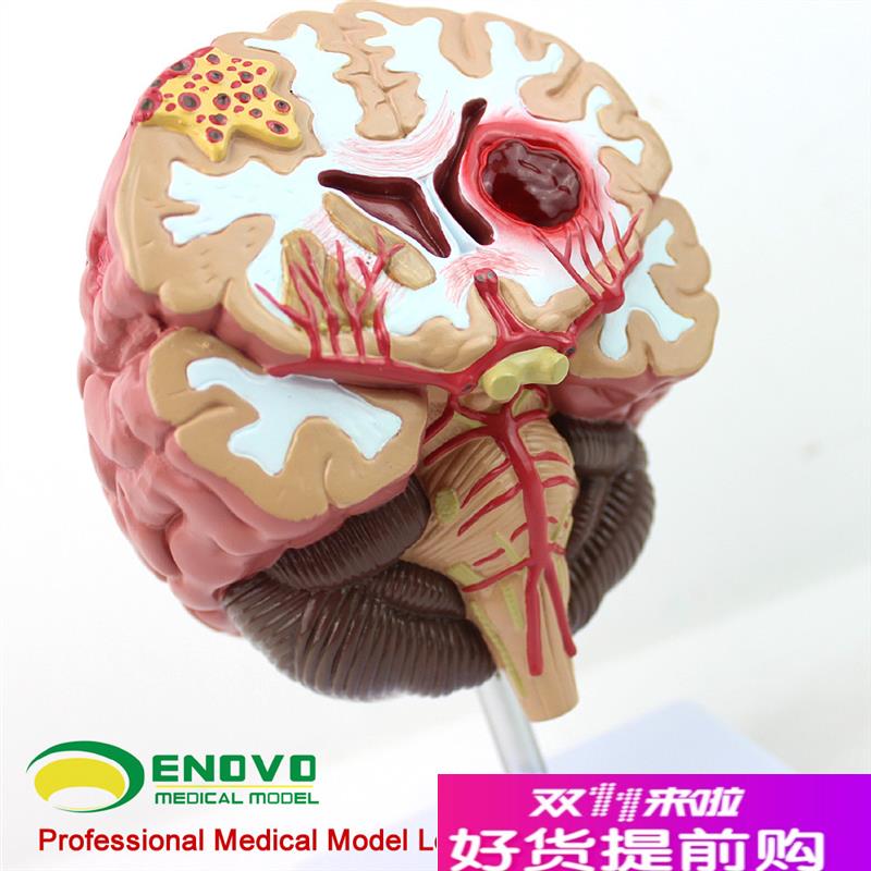 颐诺正品医用人体脑部疾u病模型大脑模型神经外科神经内科模型