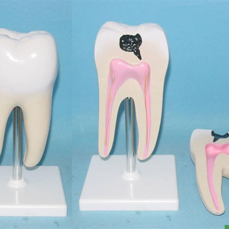 包邮人体蛀牙解剖模型牙齿牙F科展示医用教学教具教具