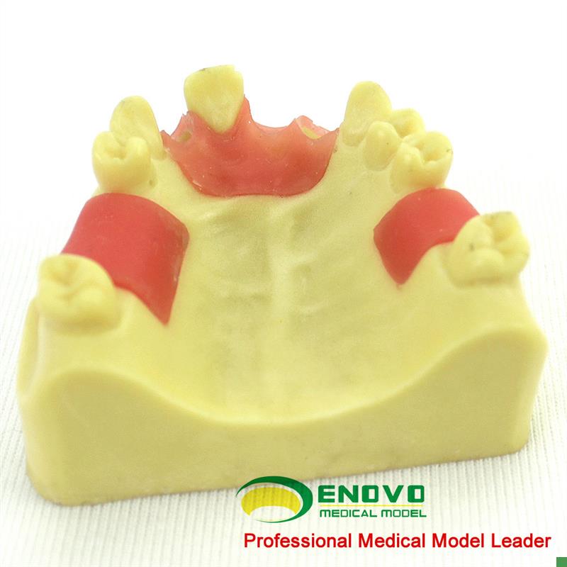 ENOVbO颐诺上颌缺失种植实训模型口腔即刻种植操作上颌骨缺失牙齿