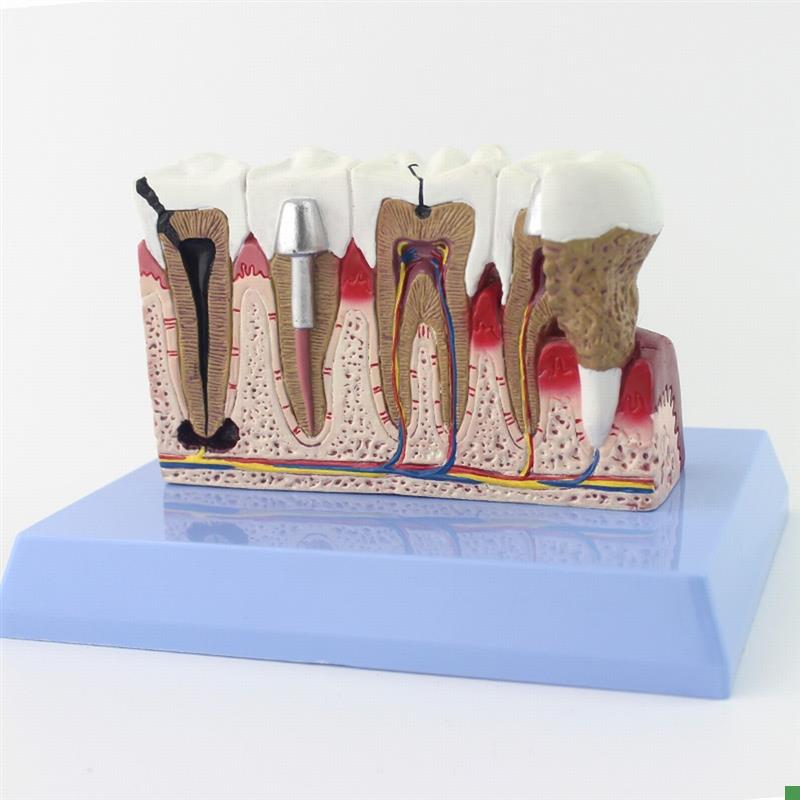 ENOVO颐诺h牙齿模型口腔牙齿科种植模型口腔病理模型口腔医院医患