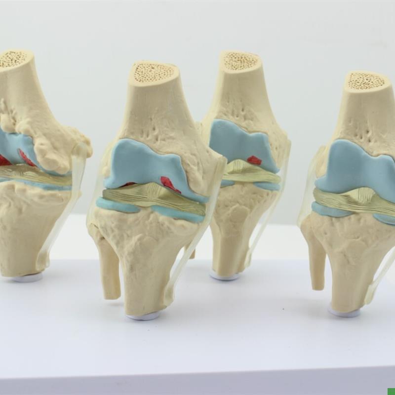 ENOVO颐诺i人体病理膝关节模型退行性血友病模型骨科管骨骼模型膝